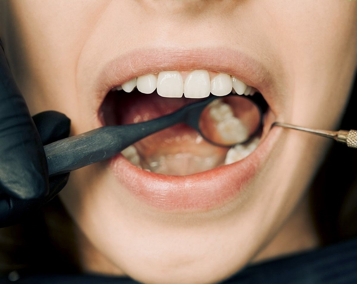 Dhëmbë, dentist. Foto nga Arvind Philomin/Pexels