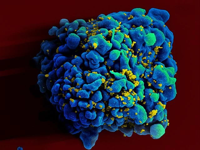 Infektimi HIV. Foto nga Wikimedia commons NIAID